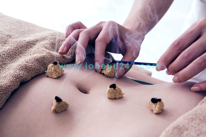 Moxibustion